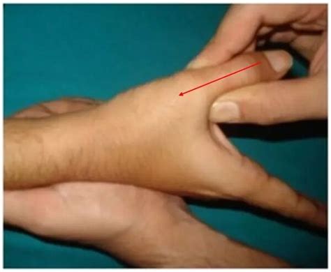 scaphoid compression test specificity|scaphoid instability test.